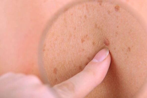 人間の皮膚の乳頭腫